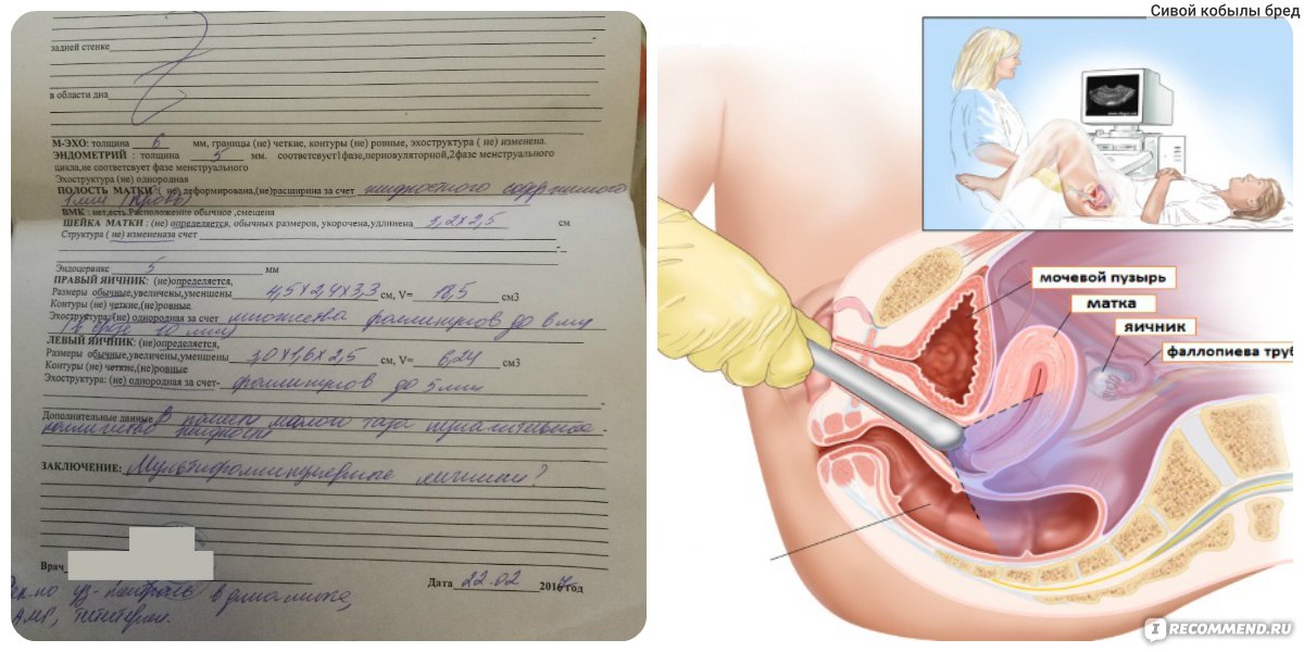 УЗИ трансвагинальным датчиком - «Все о ТРАНСВАГИНАЛЬНОМ УЗИ ...